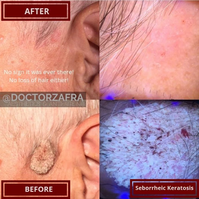 Benign Skin Lesion laser removal seborrheic keratosis 2.jpg