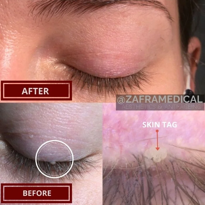 Benign Skin Lesion laser removal skin tag eye lid.jpg