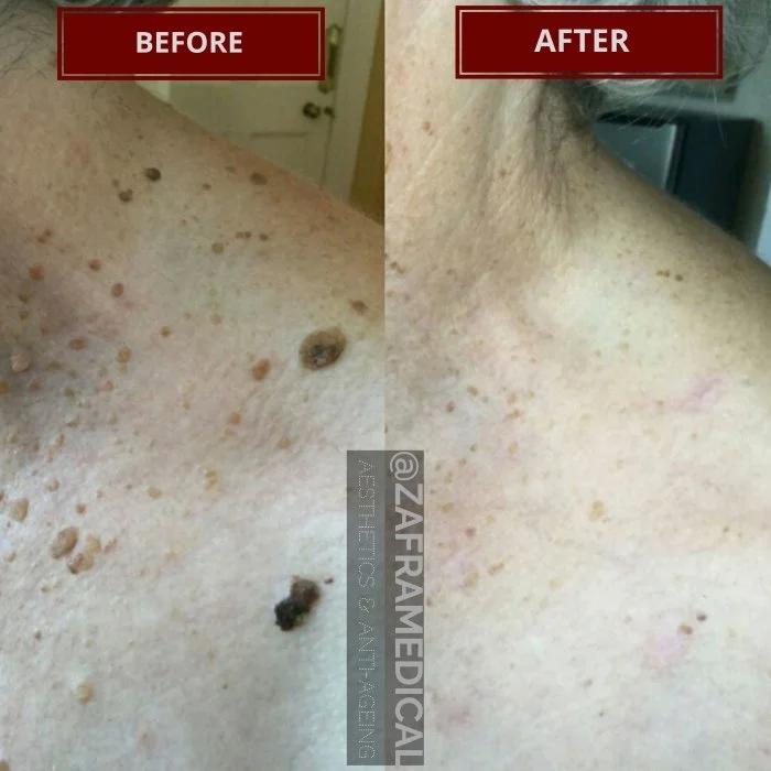 Benign Skin Lesion laser removal skin tags moles seborrheic keratosis.jpg