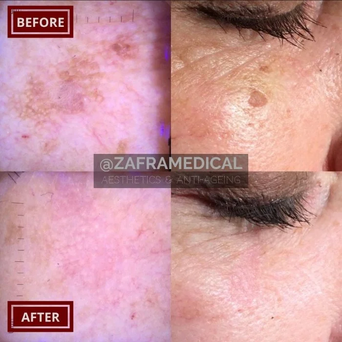Benign Skin Lesion laser removal sun damage.jpg