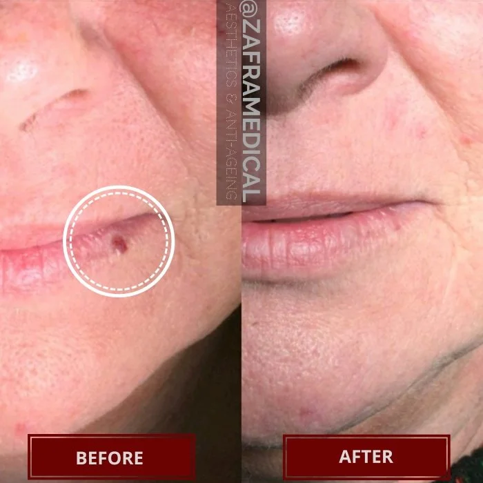 Benign Skin Lesion laser removal venous lake lip.jpg