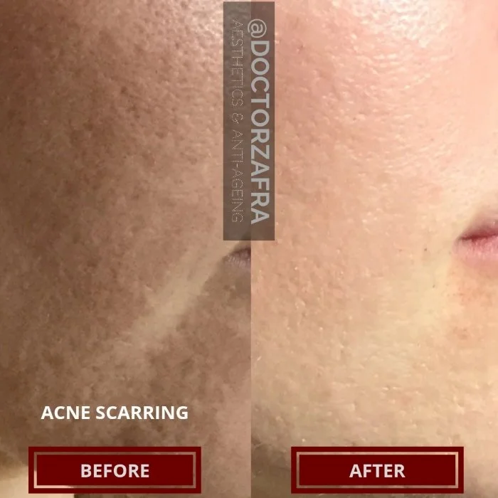 CO2 Laser Acne Scarring treatment.jpg