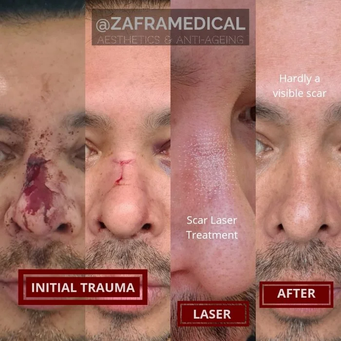 CO2 Laser Scar treatment.jpg