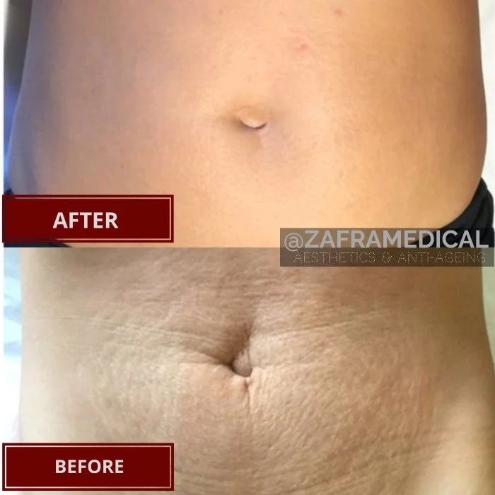 CO2 Laser Stretchmarks treatment.jpg
