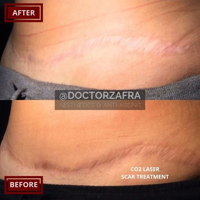 CO2 Laser Surgical Scar treatment.jpg