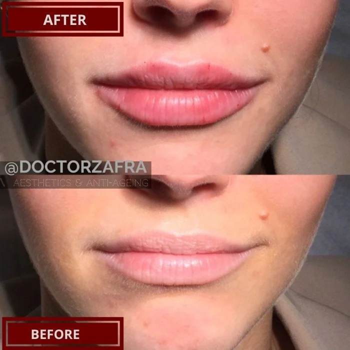 HA Dermal Filler lips 1.jpg