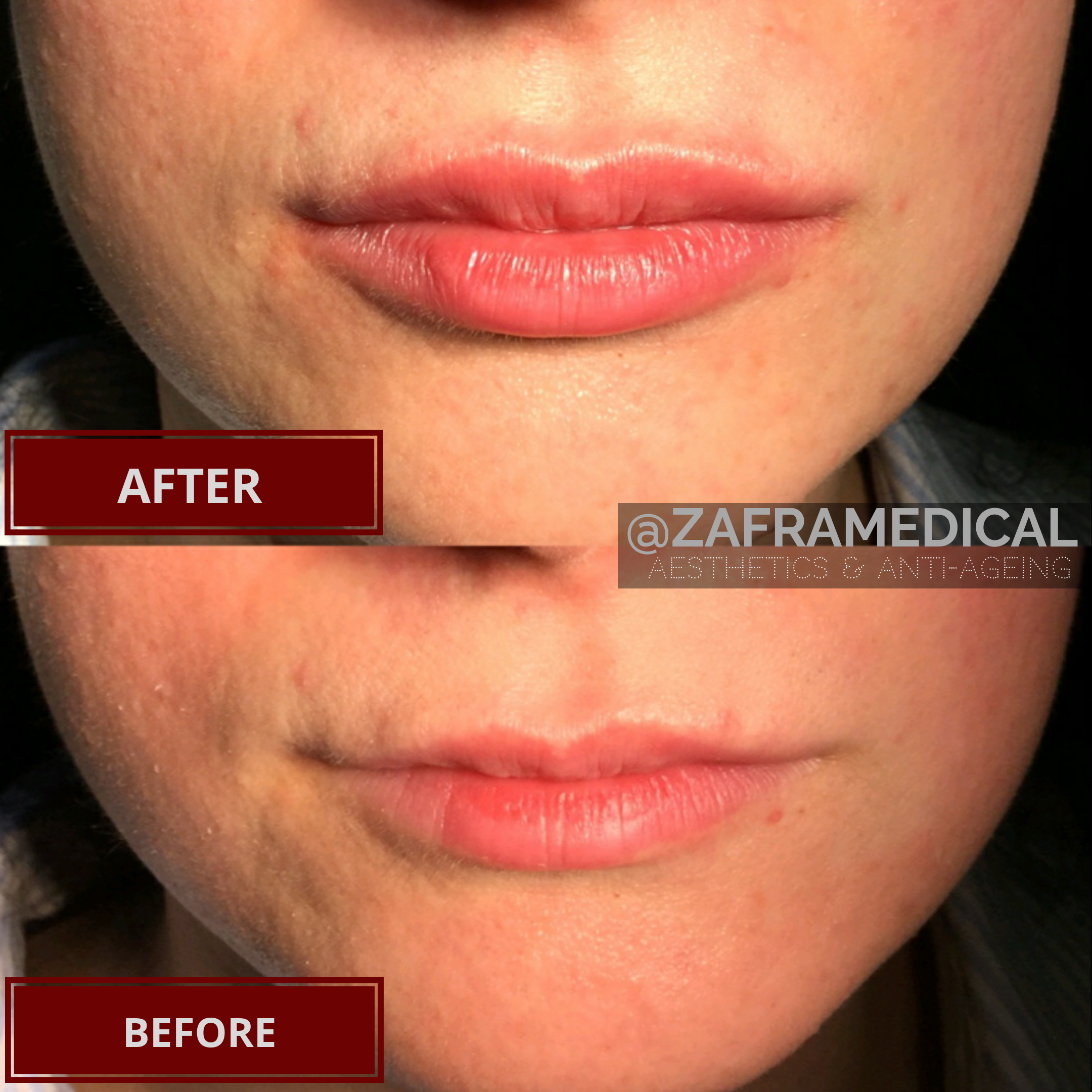 HA Dermal Filler Lips 2.png