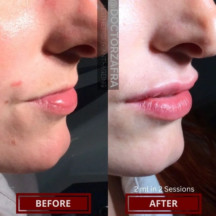 HA Dermal Filler lips 4a.jpg