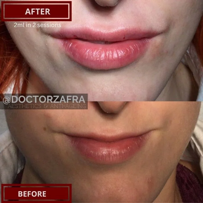 HA Dermal Filler lips 4b.jpg