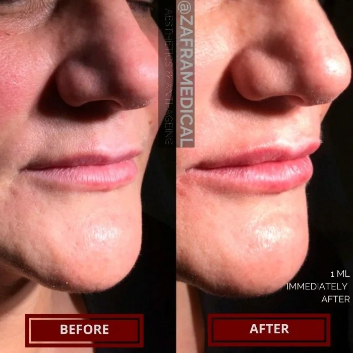 HA Dermal Filler Lips 5.jpg