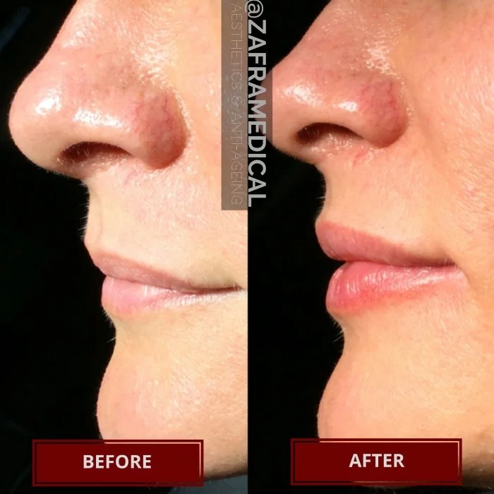 HA Dermal Filler Lips 6.jpg