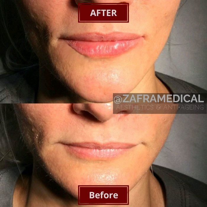HA Dermal Filler Lips 7.jpg