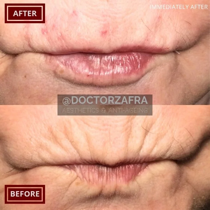 HA Dermal Filler Lips Smoker Lines.jpg