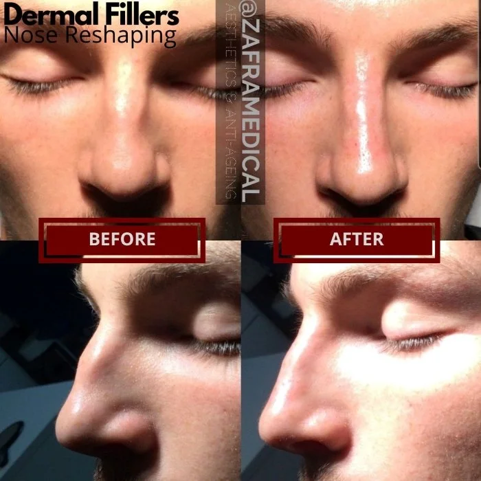 HA Dermal Filler Nose reshaping 2.jpg
