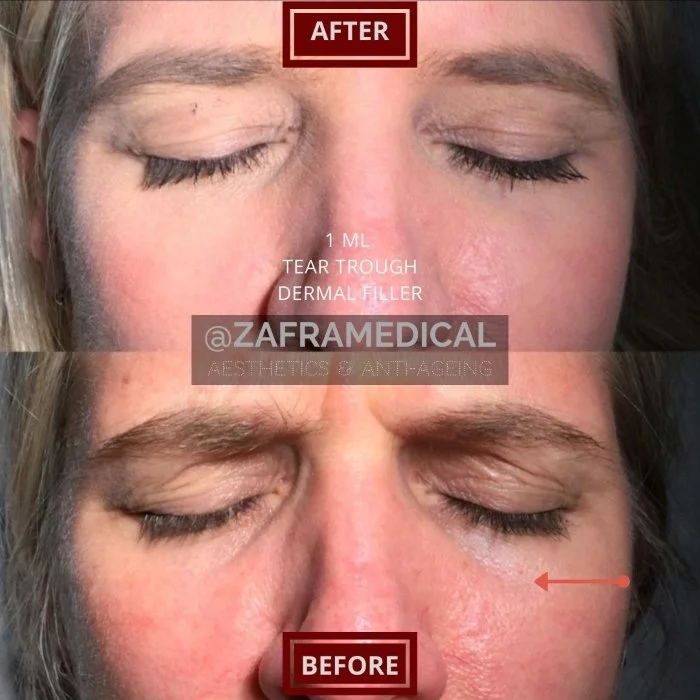 HA Dermal Filler Tear Trough 2.jpg