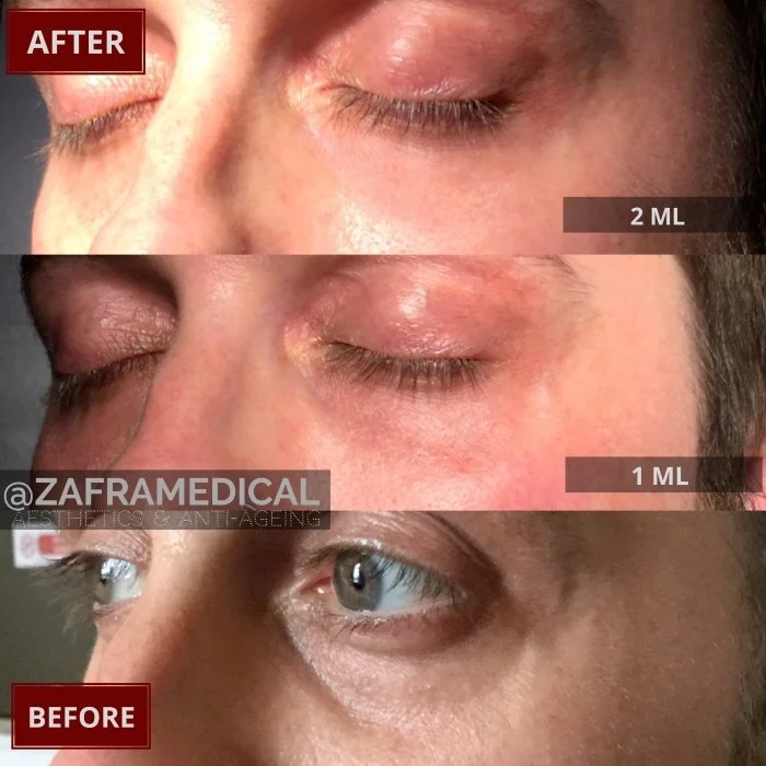 HA Dermal Filler Tear Trough 3.jpg