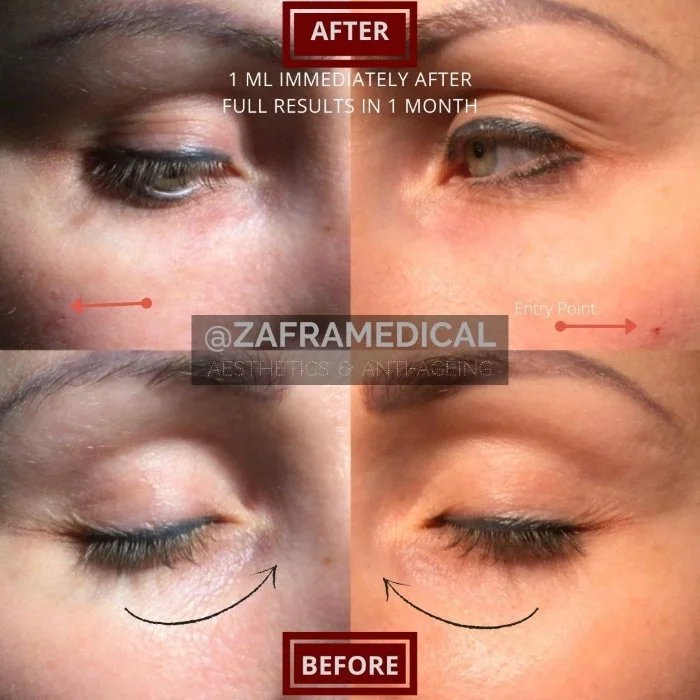 HA Dermal Filler Tear Trough 4.jpg