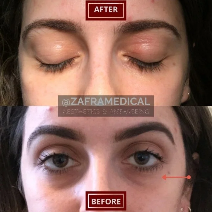 HA Dermal Filler Tear Trough.jpg