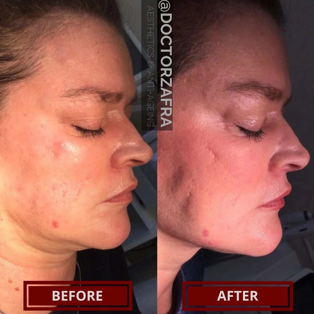 HIFU lower face skin tightening fat removal lower face double chin 1.jpg