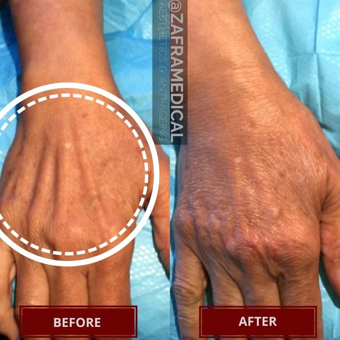 Skin rejuvenation hand.jpg