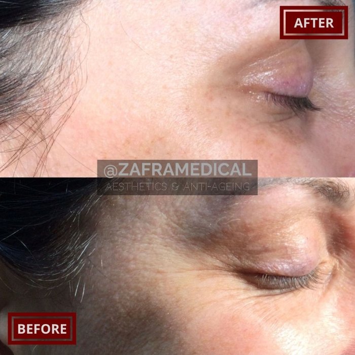 Skin Rejuvenation mesotherapy.jpg