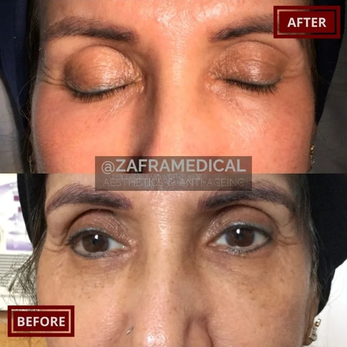 Bespoke Eye Rejuvenation.jpg