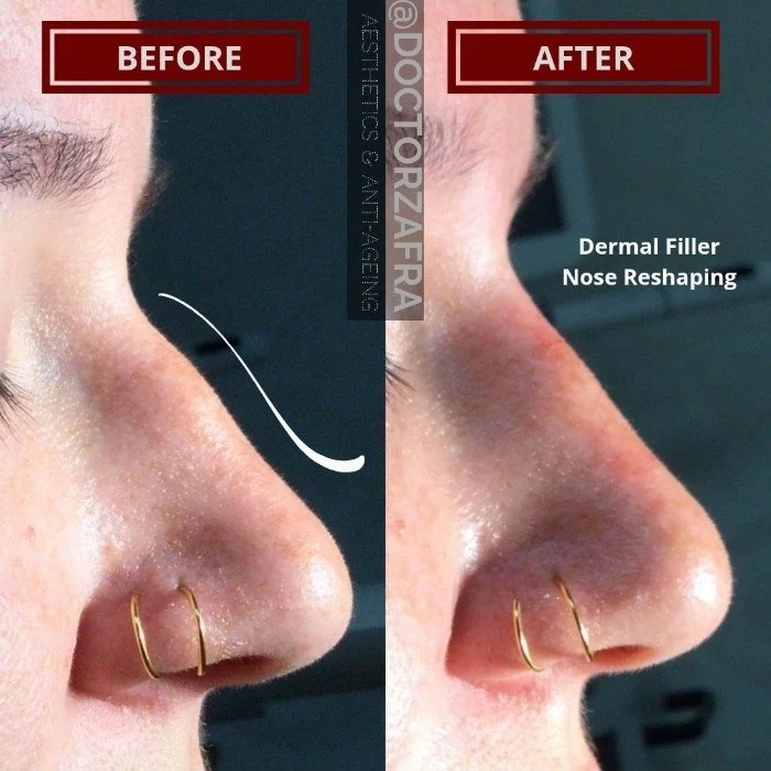 HA Dermal Filler Nose reshaping 3.jpg