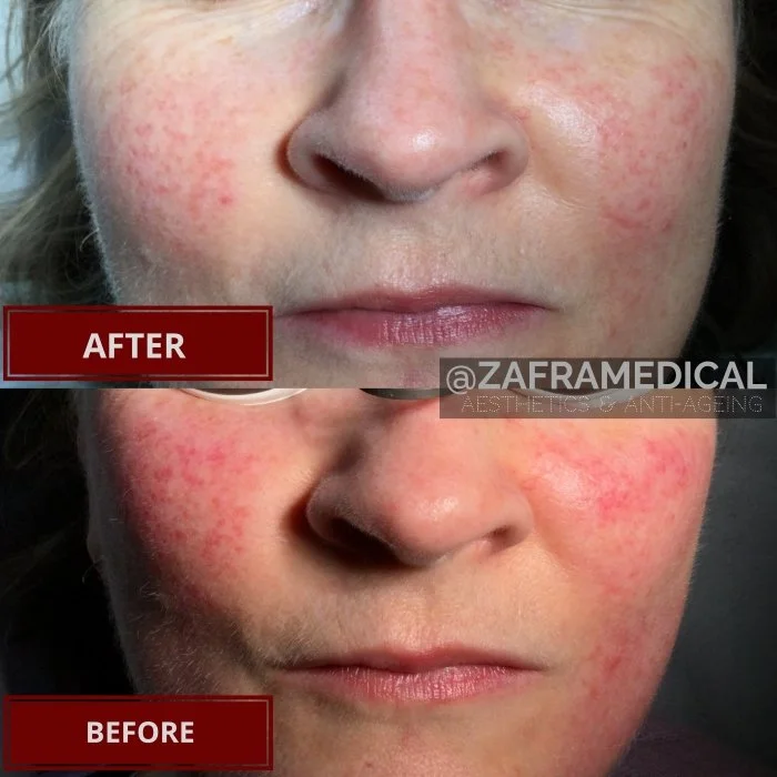 Laser Treatment Rosacea.jpg