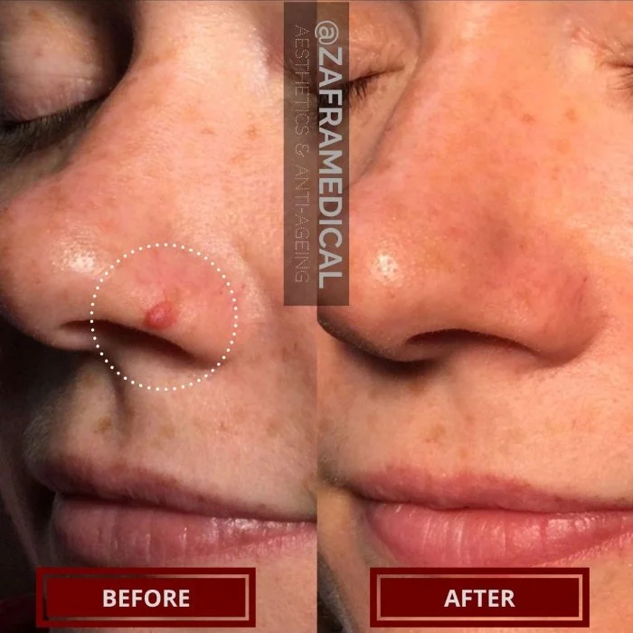 Benign Skin Lesion laser removal fibrous papule nose 3.jpg