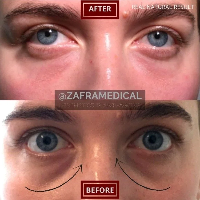 HA Dermal Filler Tear Trough 5.jpg