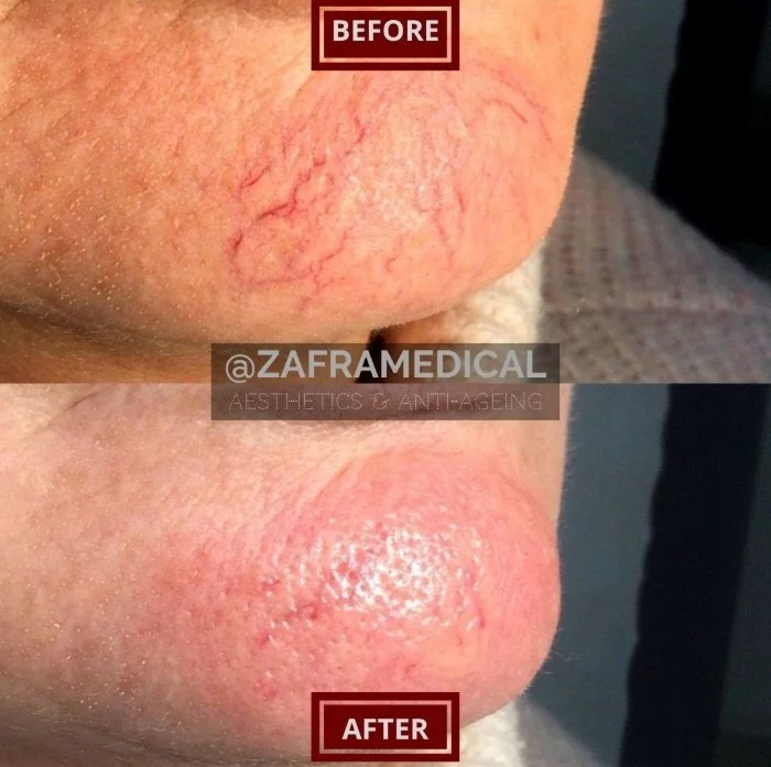 Thread spider vein treatment laser esclerotherapy.jpg