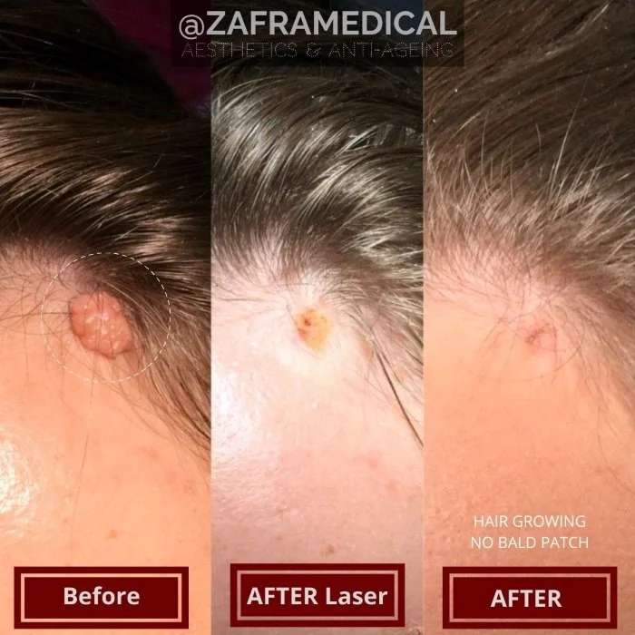 Benign Skin Lesion laser removal mole forehead 2.jpg