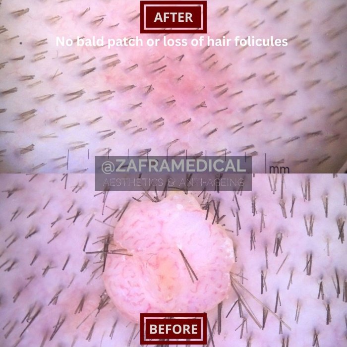 Benign Skin Lesion laser removal mole hair scalp.jpg