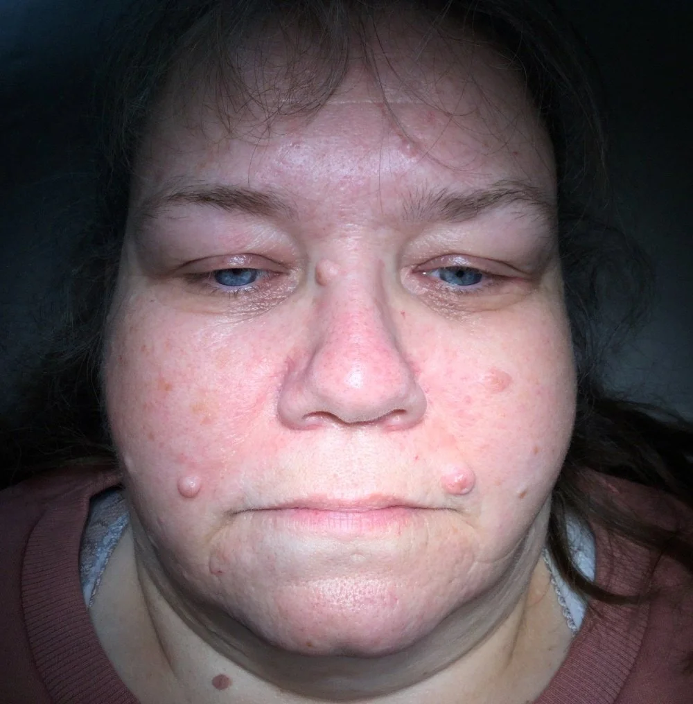Mole Removal before.jpg