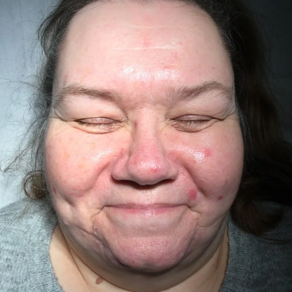 Mole Removal after.jpg