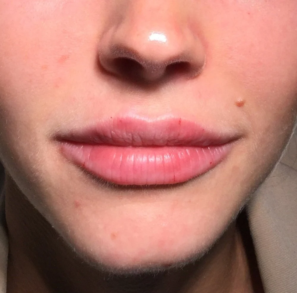 Dermal filler lips after.jpg