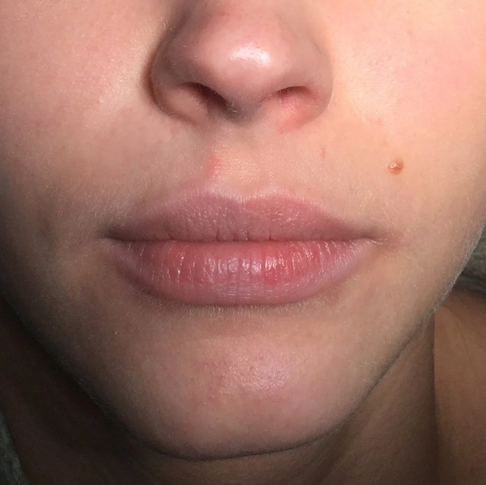Dermal filler lips before.jpg