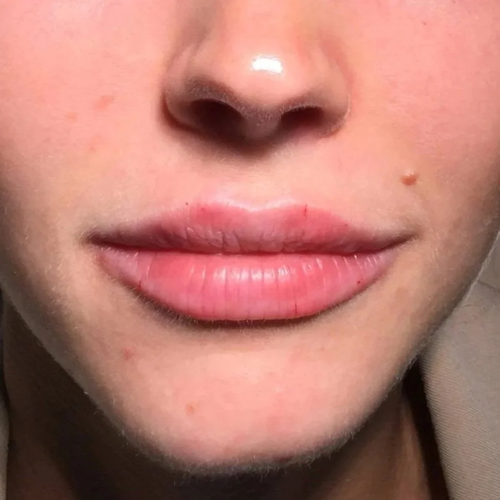 Dermal%2Bfiller%2Blips%2Bafter.jpg