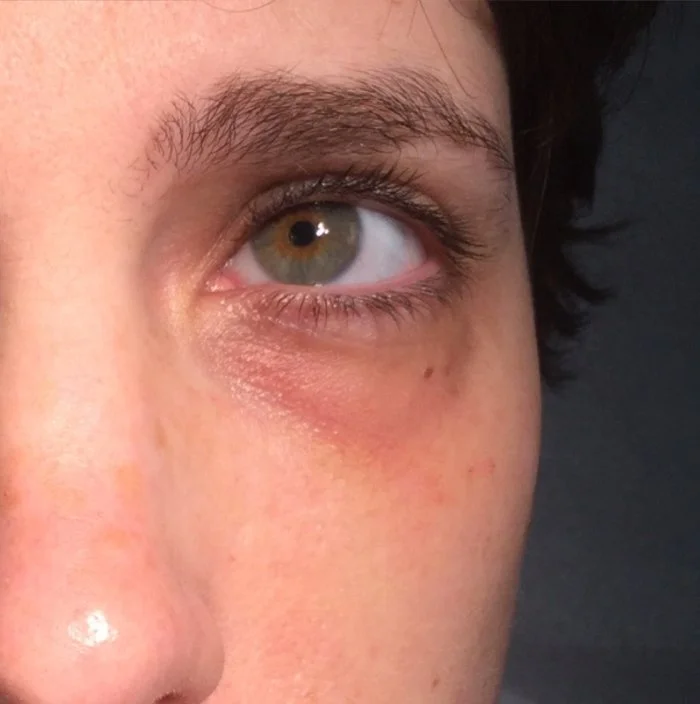 Bespoke eye rejuvenation before.jpg
