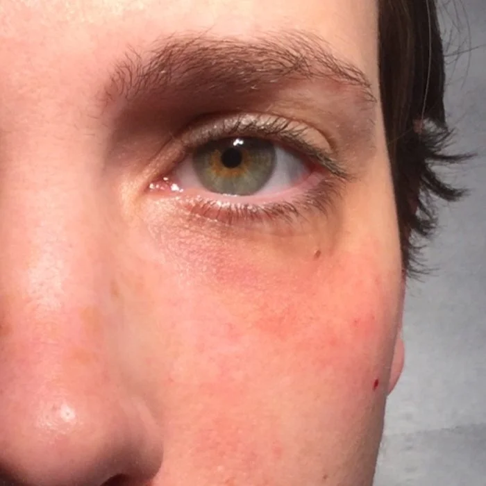 Bespoke Eye Rejuvenation after.jpg