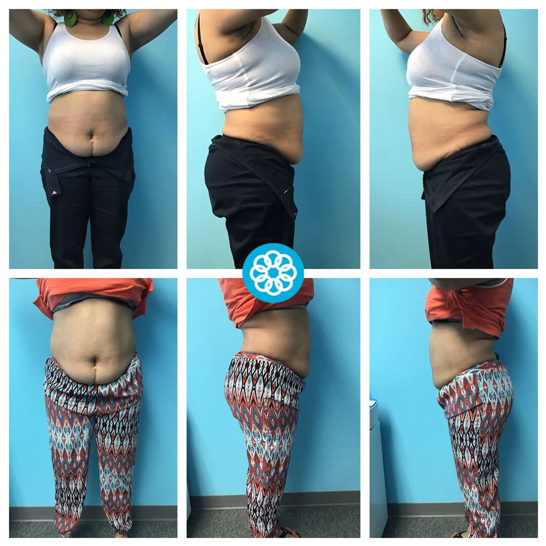 All 30+ Pictures lipo laser cavitation before and after photos Updated All 30+ Pictures lipo laser cavitation before and after photos Updated