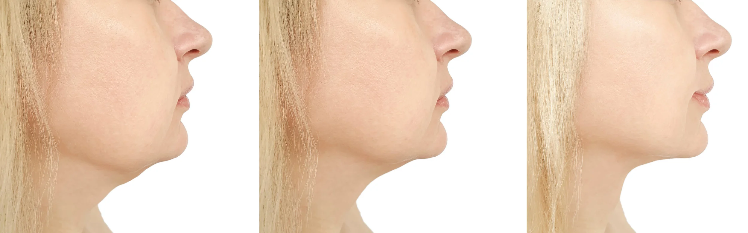 RF Neck Results (Female)