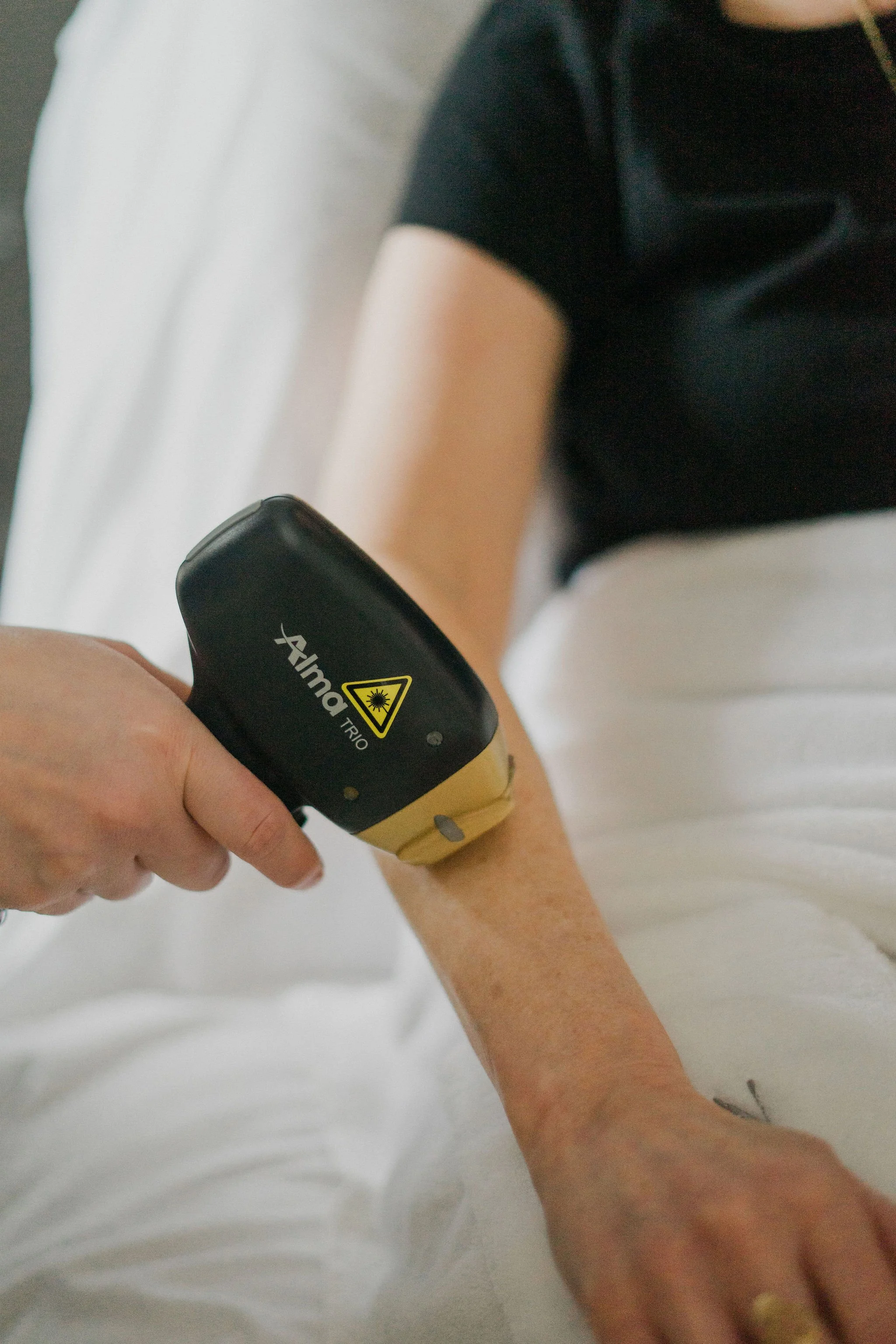 laser hair removal