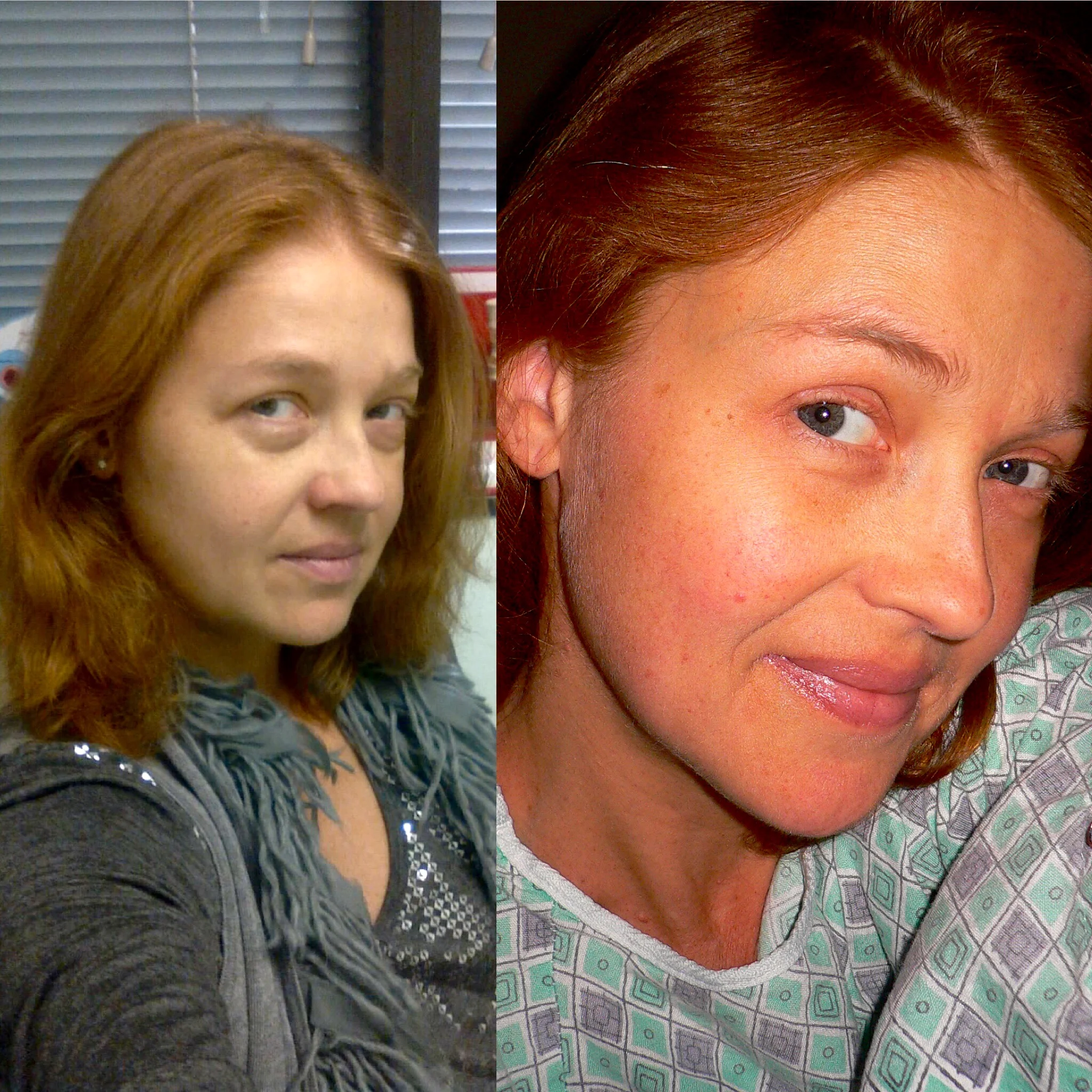 March 8th, 2011 vs. April 11th, 2011. 7% kidney function vs. Three days after transplant.