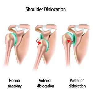 shoulder-dislocation-500x500.jpeg