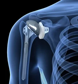 shoulderreplacement.jpg
