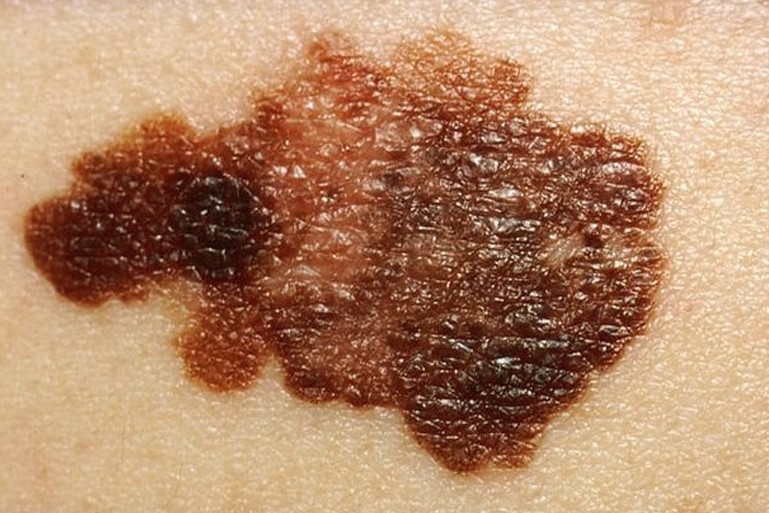 superficial-spreading-melanoma.jpg