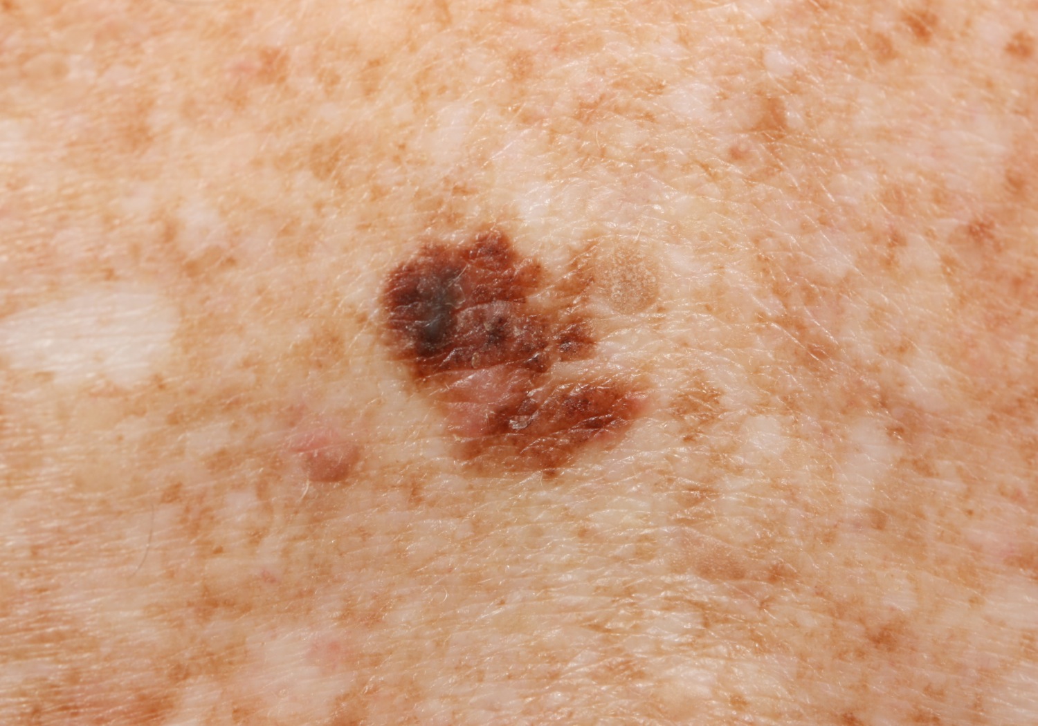 Melanoma30.jpg