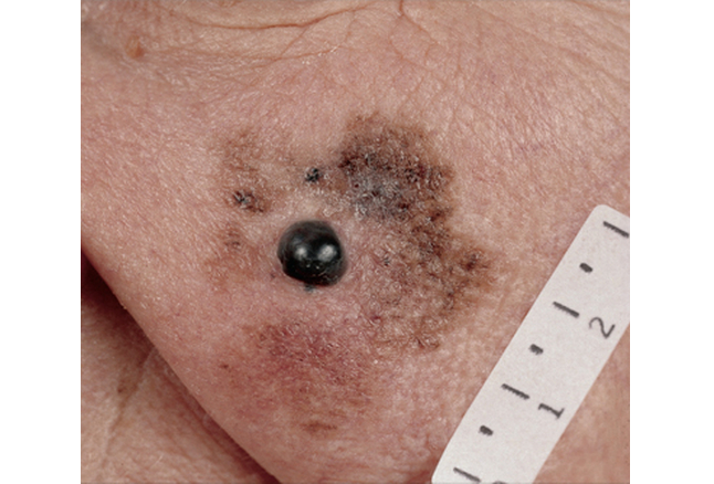 FCASCD_lentigo_maligna_melanoma.png