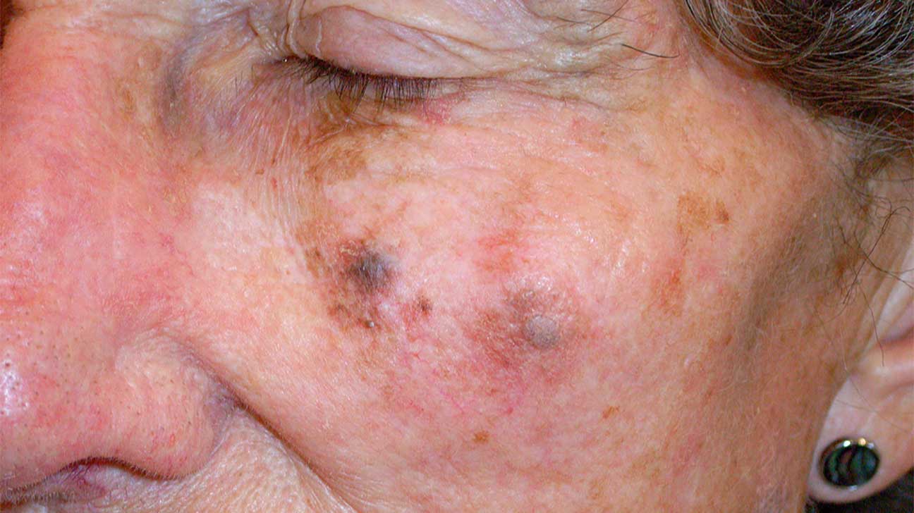 2308-mild_lentigo_maligna_melanoma-1296x728-slide2.jpg